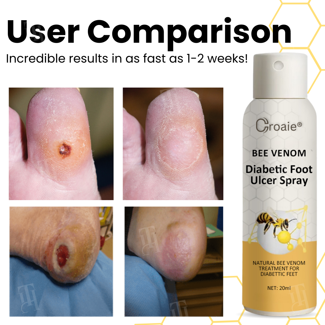 Croaie® Bee Venom Diabetic Foot Ulcer Spray ✅ 𝐕𝐢𝐬𝐢𝐛𝐥𝐞 𝐢𝐦𝐩𝐫𝐨𝐯𝐞𝐦𝐞𝐧𝐭 𝐢𝐧 𝟐-𝟑 𝐰𝐞𝐞𝐤𝐬✅