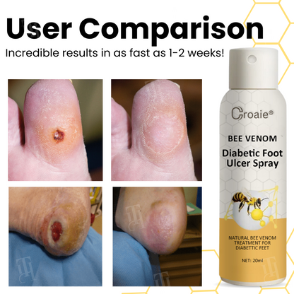 Croaie® Bee Venom Diabetic Foot Ulcer Spray ✅ 𝐕𝐢𝐬𝐢𝐛𝐥𝐞 𝐢𝐦𝐩𝐫𝐨𝐯𝐞𝐦𝐞𝐧𝐭 𝐢𝐧 𝟐-𝟑 𝐰𝐞𝐞𝐤𝐬✅