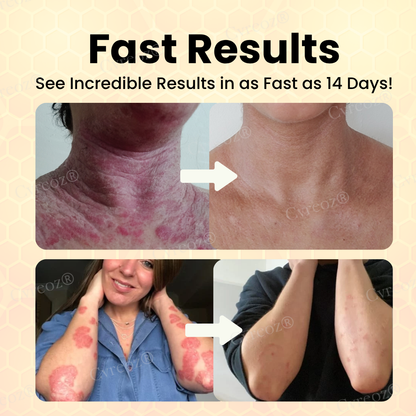 Cvreoz® Bee Venom Psoriasis Cream ✨See Visible Improvement in Just 7 Days✨