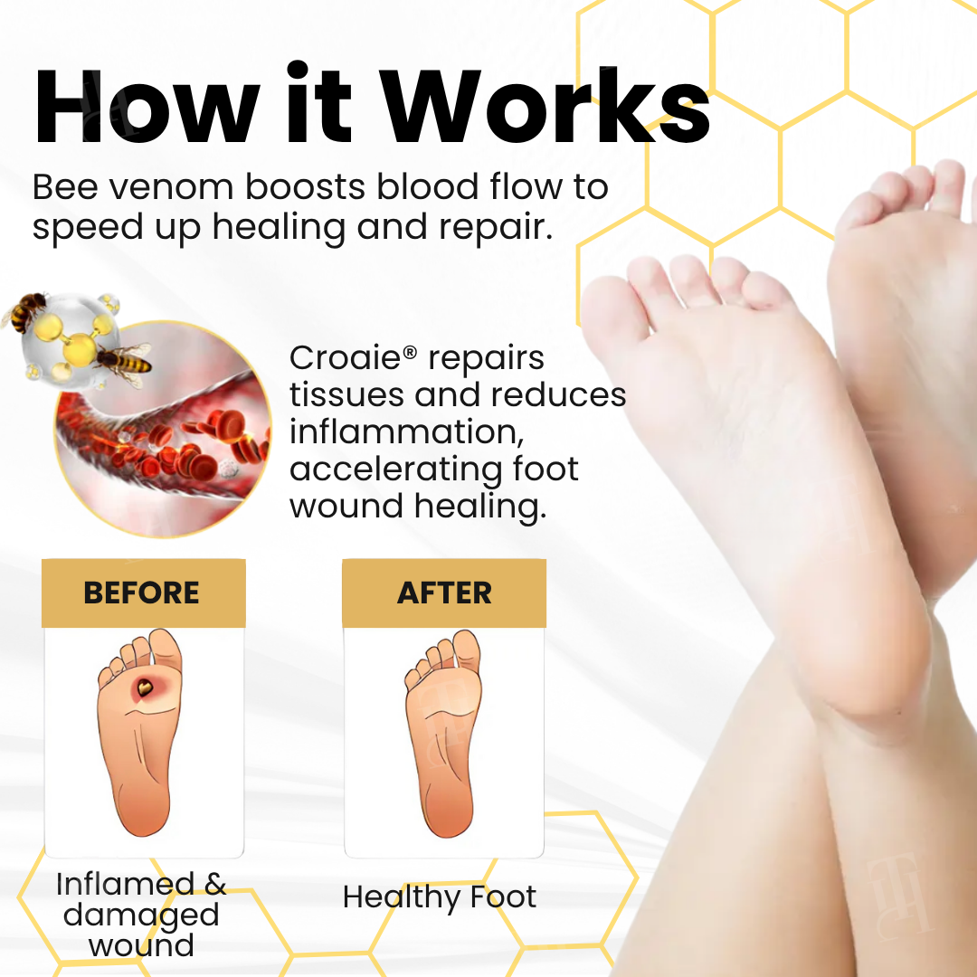 Croaie® Bee Venom Diabetic Foot Ulcer Spray ✅ 𝐕𝐢𝐬𝐢𝐛𝐥𝐞 𝐢𝐦𝐩𝐫𝐨𝐯𝐞𝐦𝐞𝐧𝐭 𝐢𝐧 𝟐-𝟑 𝐰𝐞𝐞𝐤𝐬✅