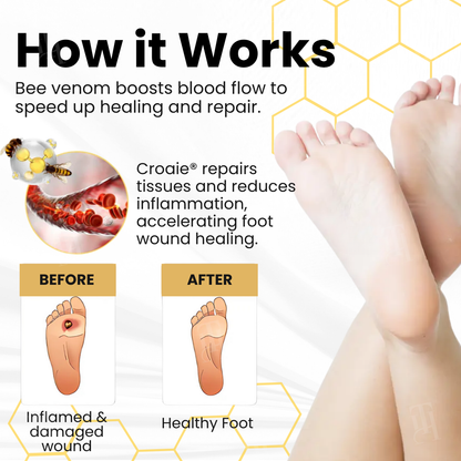 Croaie® Bee Venom Diabetic Foot Ulcer Spray ✅ 𝐕𝐢𝐬𝐢𝐛𝐥𝐞 𝐢𝐦𝐩𝐫𝐨𝐯𝐞𝐦𝐞𝐧𝐭 𝐢𝐧 𝟐-𝟑 𝐰𝐞𝐞𝐤𝐬✅