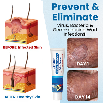 Croaie® Nanolipo Genital Warts Relief Cream🚀𝐂𝐨𝐦𝐩𝐥𝐞𝐭𝐞 𝐆𝐞𝐧𝐢𝐭𝐚𝐥 𝐑𝐞𝐬𝐭𝐨𝐫𝐚𝐭𝐢𝐨𝐧 𝐢𝐧 𝟏𝟒 𝐃𝐚𝐲𝐬🚀