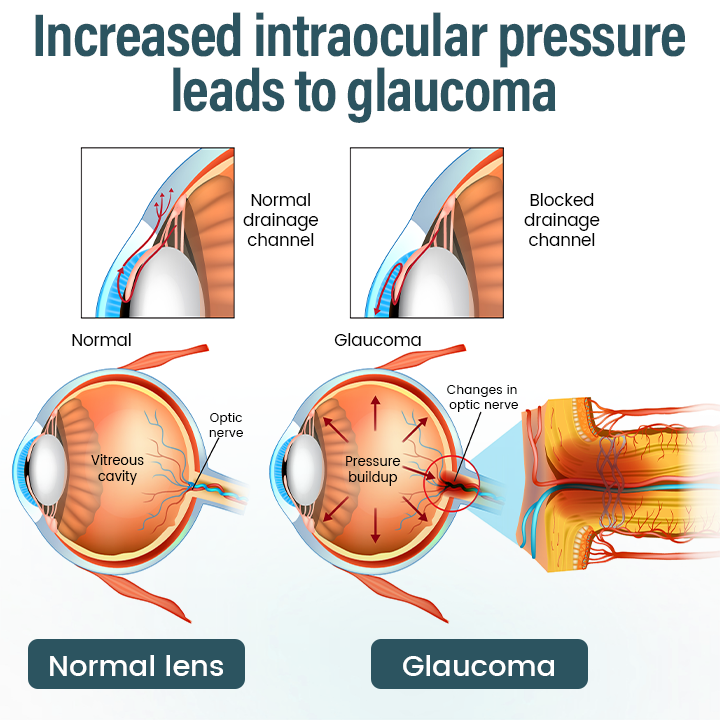 Timilk® OptiFusion Nano Eye Drops Serum —Nano Technology Restores Clear Vision,  No Glasses, No Surgery