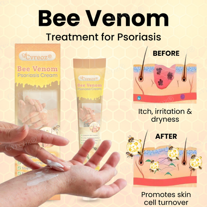 Cvreoz® Bee Venom Psoriasis Cream ✨See Visible Improvement in Just 7 Days✨